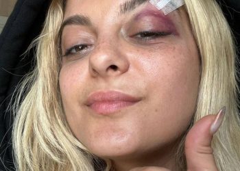 Bebe Rexha doing ‘good’ after being struck in the face mid-concert